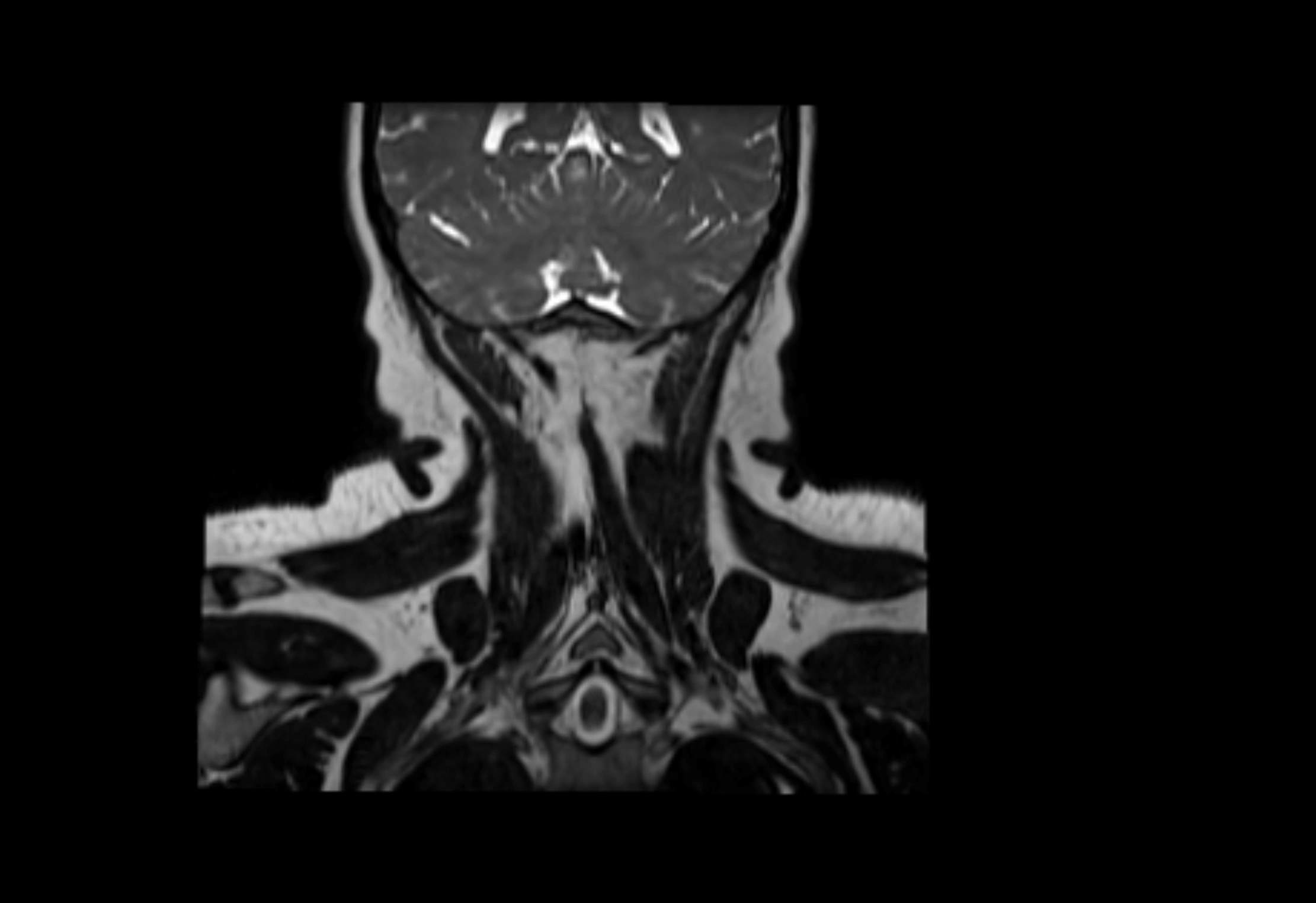 Neck coronal lymph node cross sectional MRI anatomy 3T MRI  image-img-00001-00012.webp